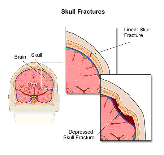Figure 2. Skull Fractures