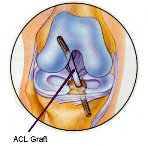 ACL reconstruction is one of the most common surgical procedures performed on the injured knee. The anterior cruciate ligament is an intraarticular (within the joint) ligament, and as such heals poorly. For this reason, it is almost always reconstructed with a substitute ligament, rather than being repaired.